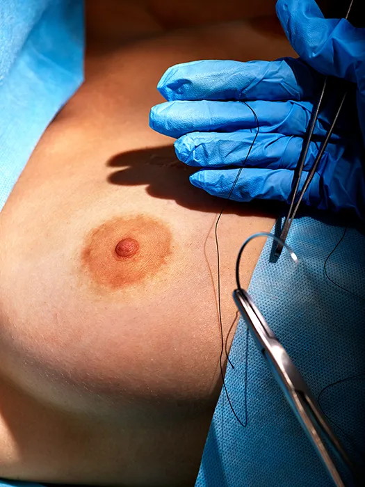 areola correction surgery