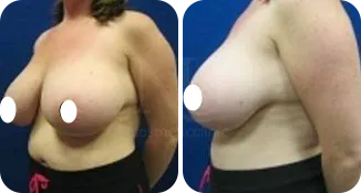 breast reduction surgery patient before and after result-5-v2