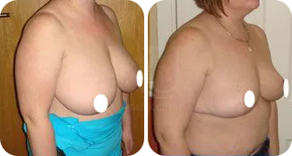 breast reduction surgery patient before and after result-8-v2