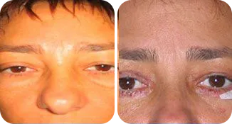 eyebag removal before and after result