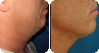 facial vaser lipo before and after result