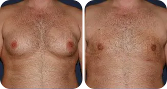 liposuction male patient before and after result-1