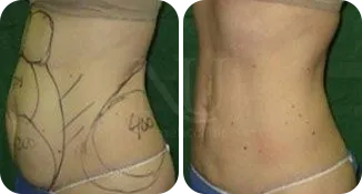 liposuction patient before and after result-1