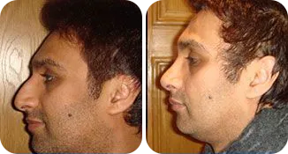 rhinoplasty patient before and after result-1