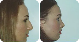 rhinoplasty patient before and after result-1