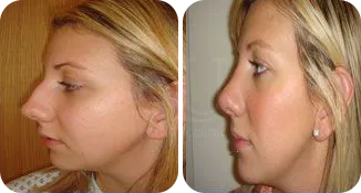 rhinoplasty patient before and after result-9