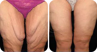 thigh liposuction patient before and after result-5