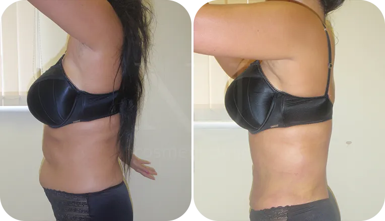 abdomen and flanks vaser liposuction patient before and after result