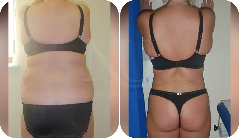 back vaser liposuction patient before and after result-1