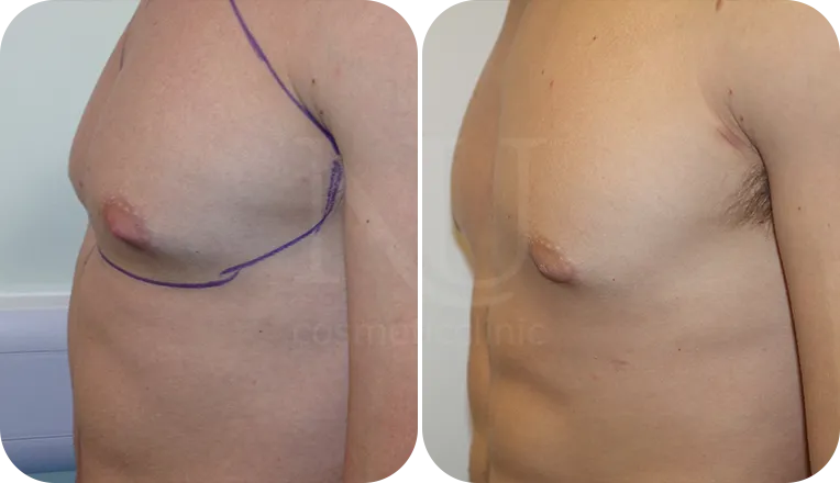 gynaecomastia surgery patient before and after result-4-v1