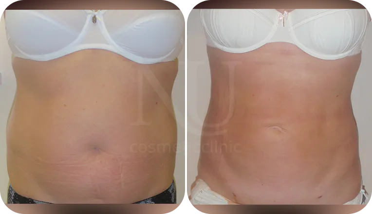 stomach vaser liposuction patient before and after result-4