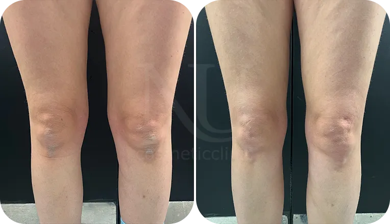 thigh liposuction patient before and after result-2