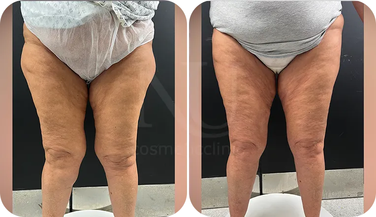 thigh liposuction patient before and after result-3