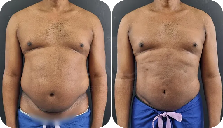 vaser lipo male before and after result-1