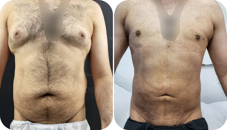 vaser lipo male before and after result