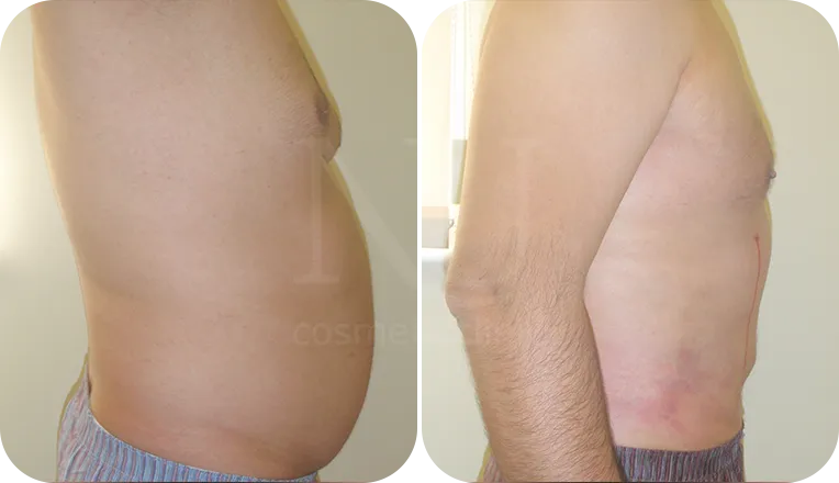 vaser liposuction male before and after result-2