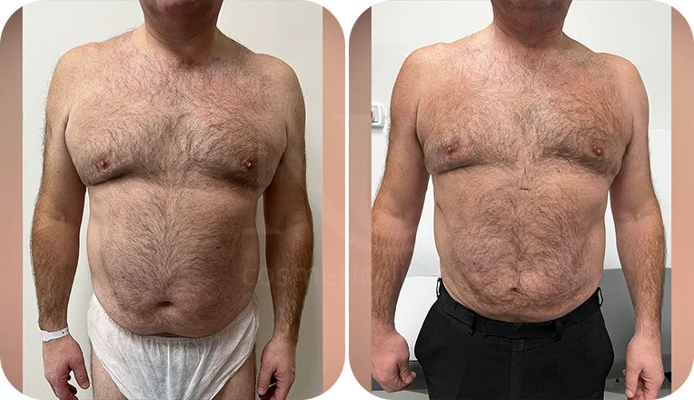 vaser liposuction male before and after result