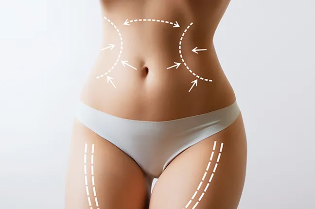 vaser liposuction in birmingham